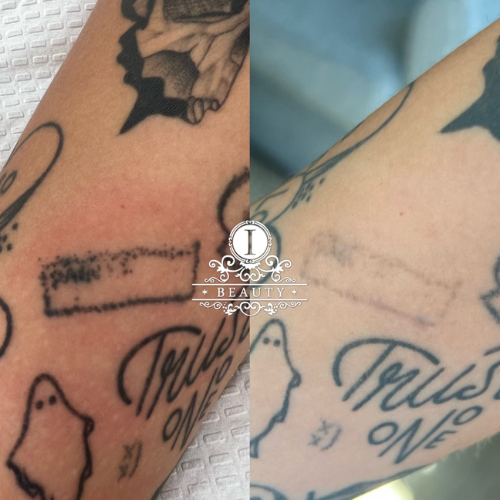Laser Tattoo Removal ibeauty makeover