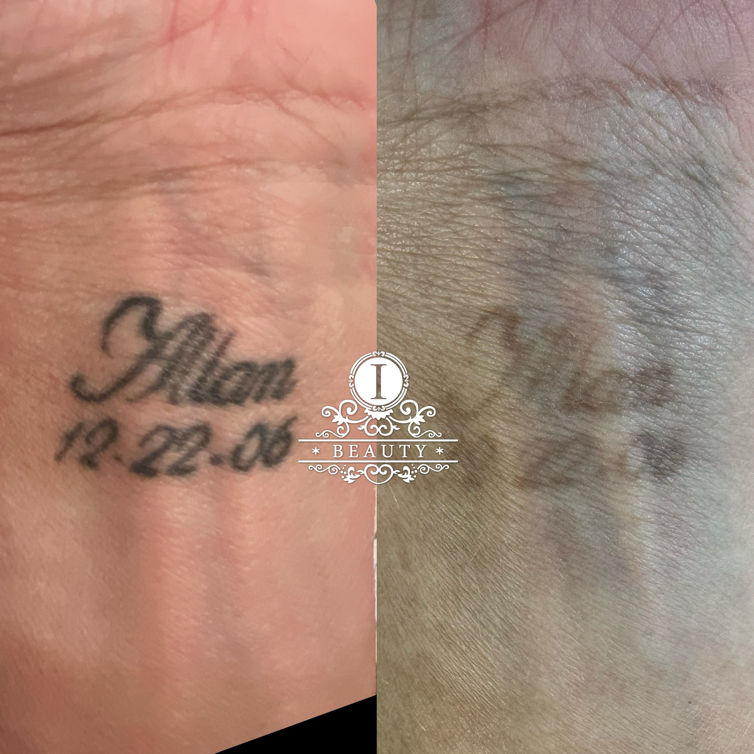 Laser tattoo removal healing at iBeauty Makeover in Boca Raton, FL